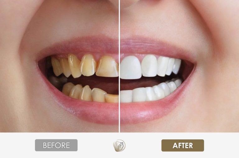 Before & After 2
